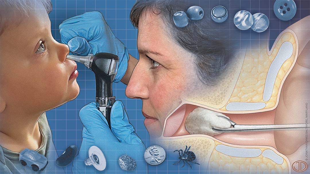 Foreign Body Removal